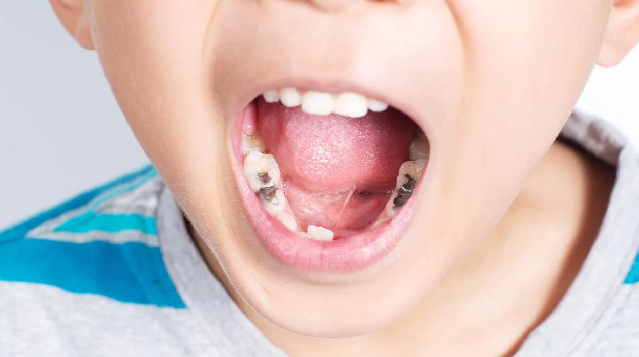 Caries niños