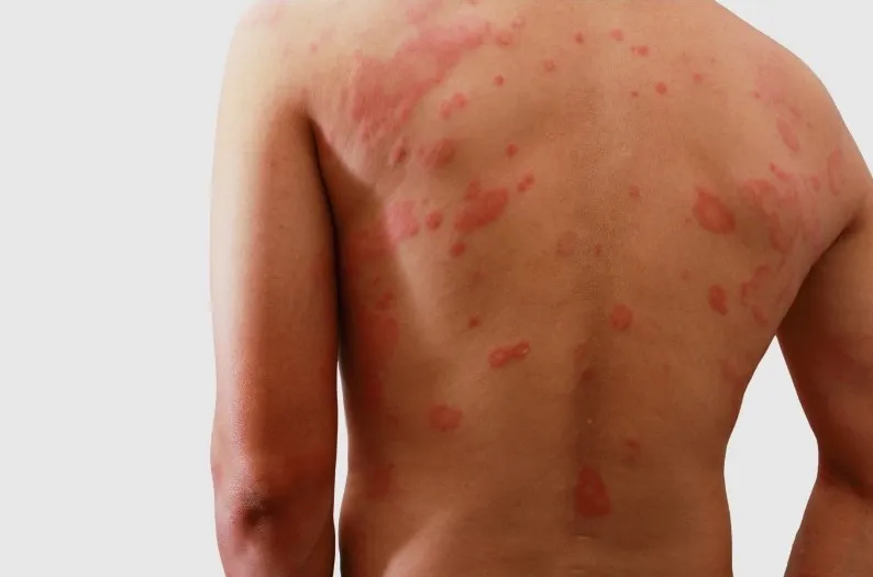 Dermatitis Atopica