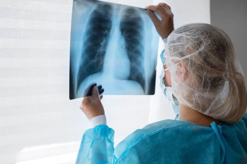 Tuberculosis