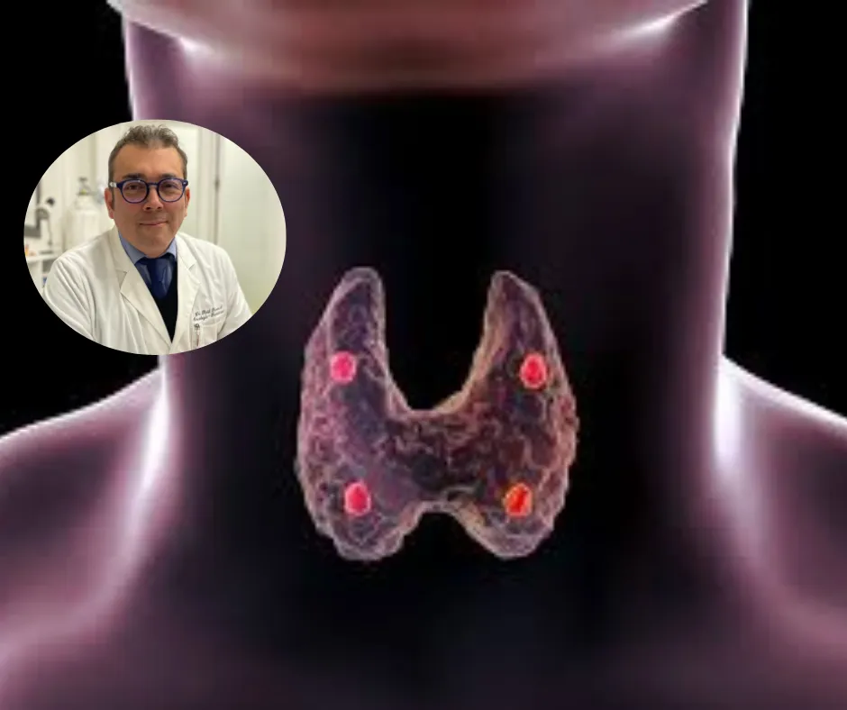 Cancer de Tiroides_Dr Rivera