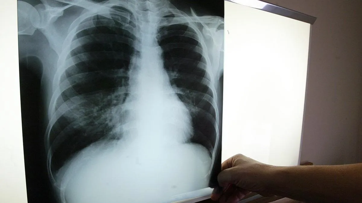 tuberculosis_región